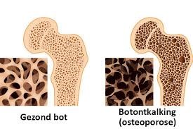 osteporose